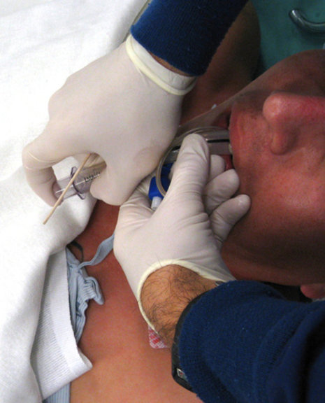 laryngeal-mask-airway-insertion