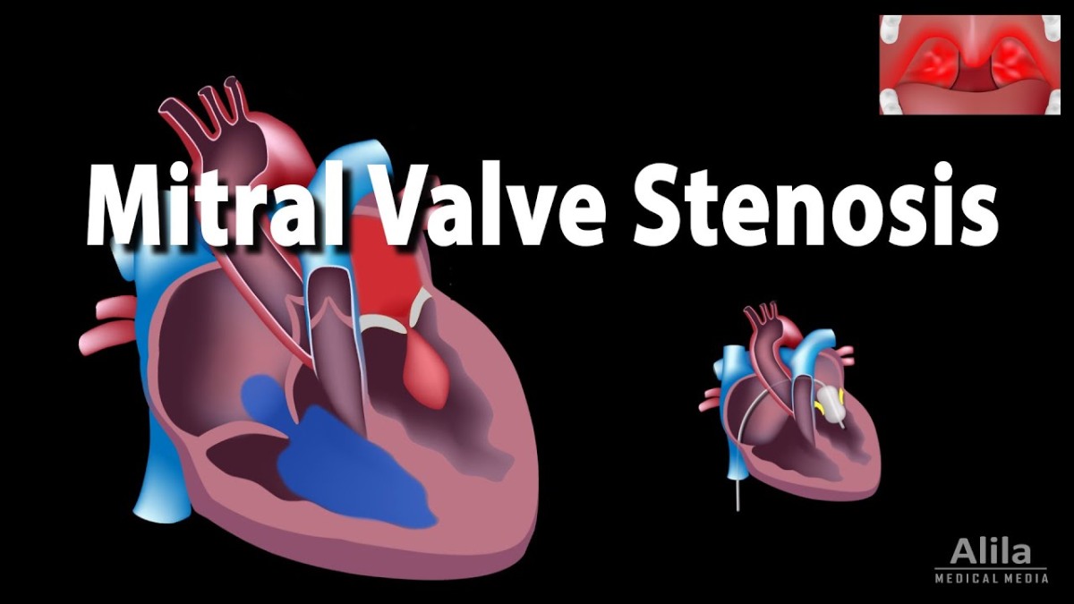 MITRAL STENOSIS – Anaesthetic Management – Anaesthesia News
